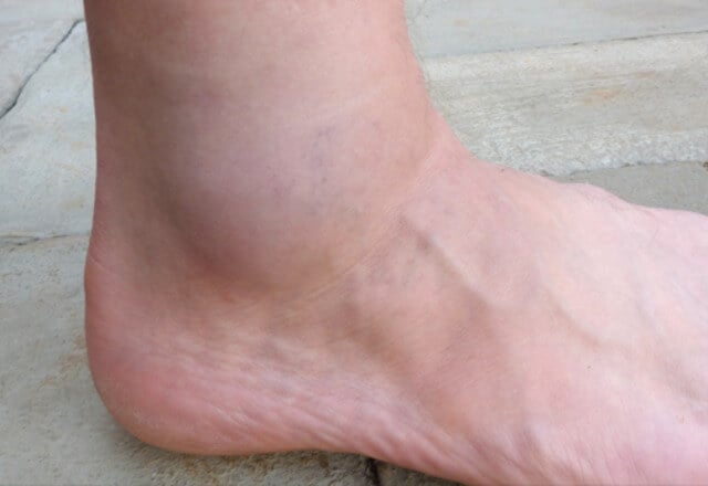 Bolovi u stopalima gležnjevima
