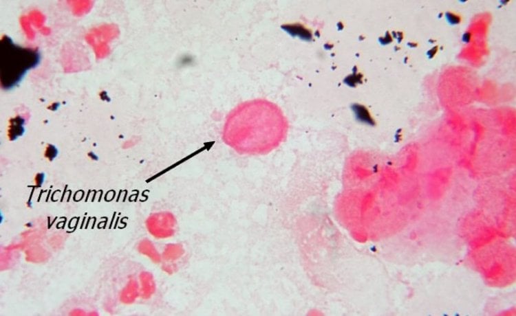 Trichomoniasis