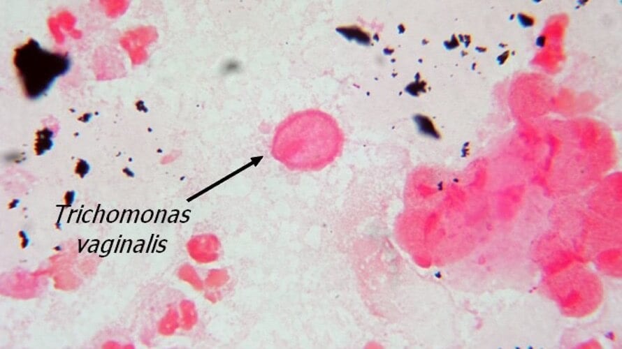 Kenet a gonococcusokra és a Trichomonas normára