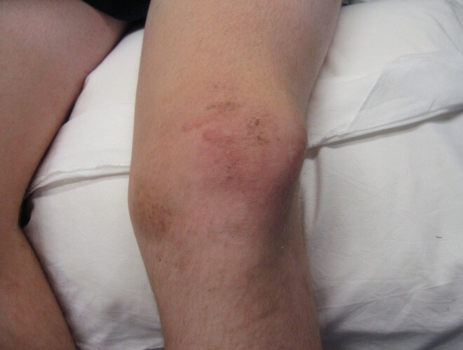artroza koljena operacija forum