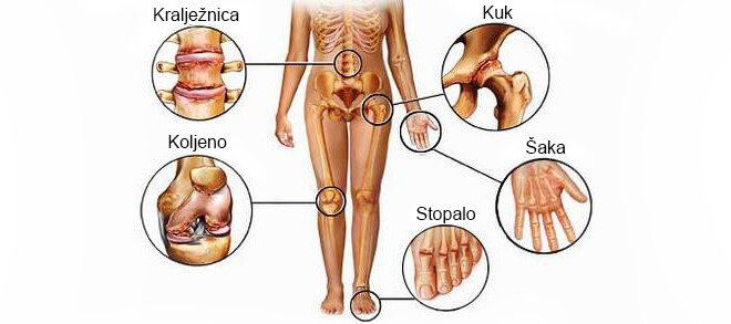 artroza koljena forum
