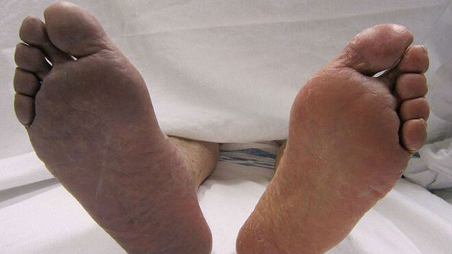 liječenje osteoartritisa cijene stopala